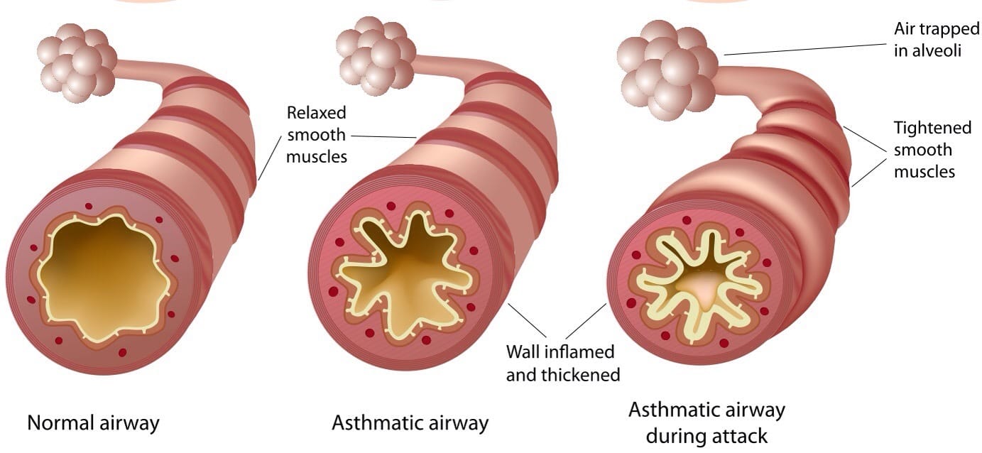 asthma-umc