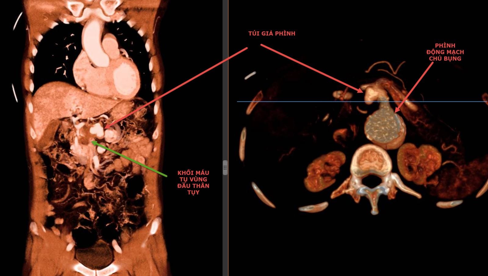 Hình CT cho thấy khối giả phình và khối máu tụ của người bệnh trước can thiệp