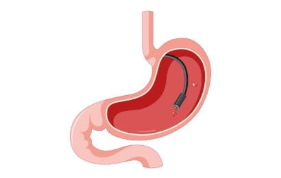 Lớp Nội soi dạ dày